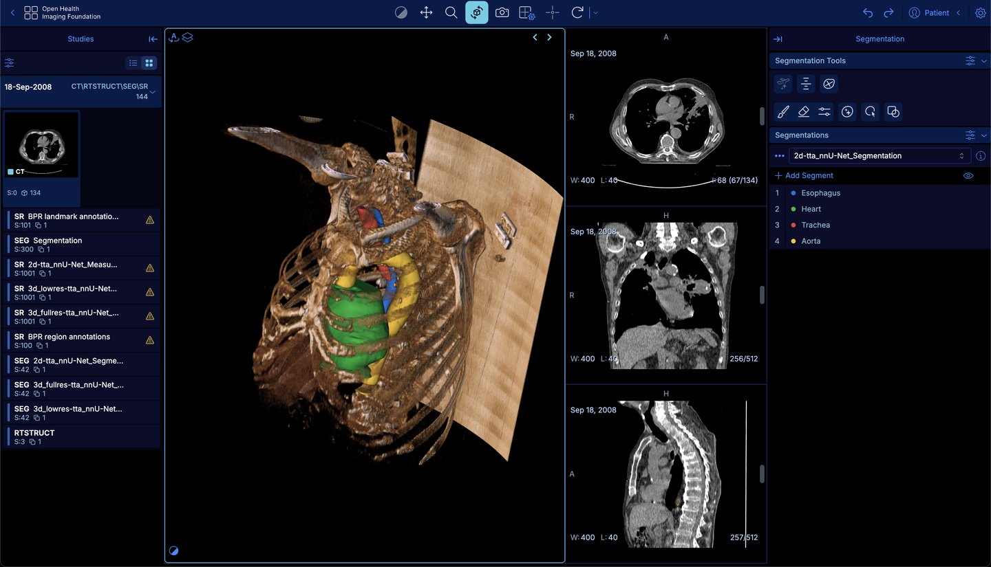The OHIF Viewer showing a 3D volume rendering of a chest CT with segmented heart, aorta, trachea and esophagus beside axial, coronal and sagittal views, with segmentation tools and SEG, SR and RTSTRUCT series in the side panels
