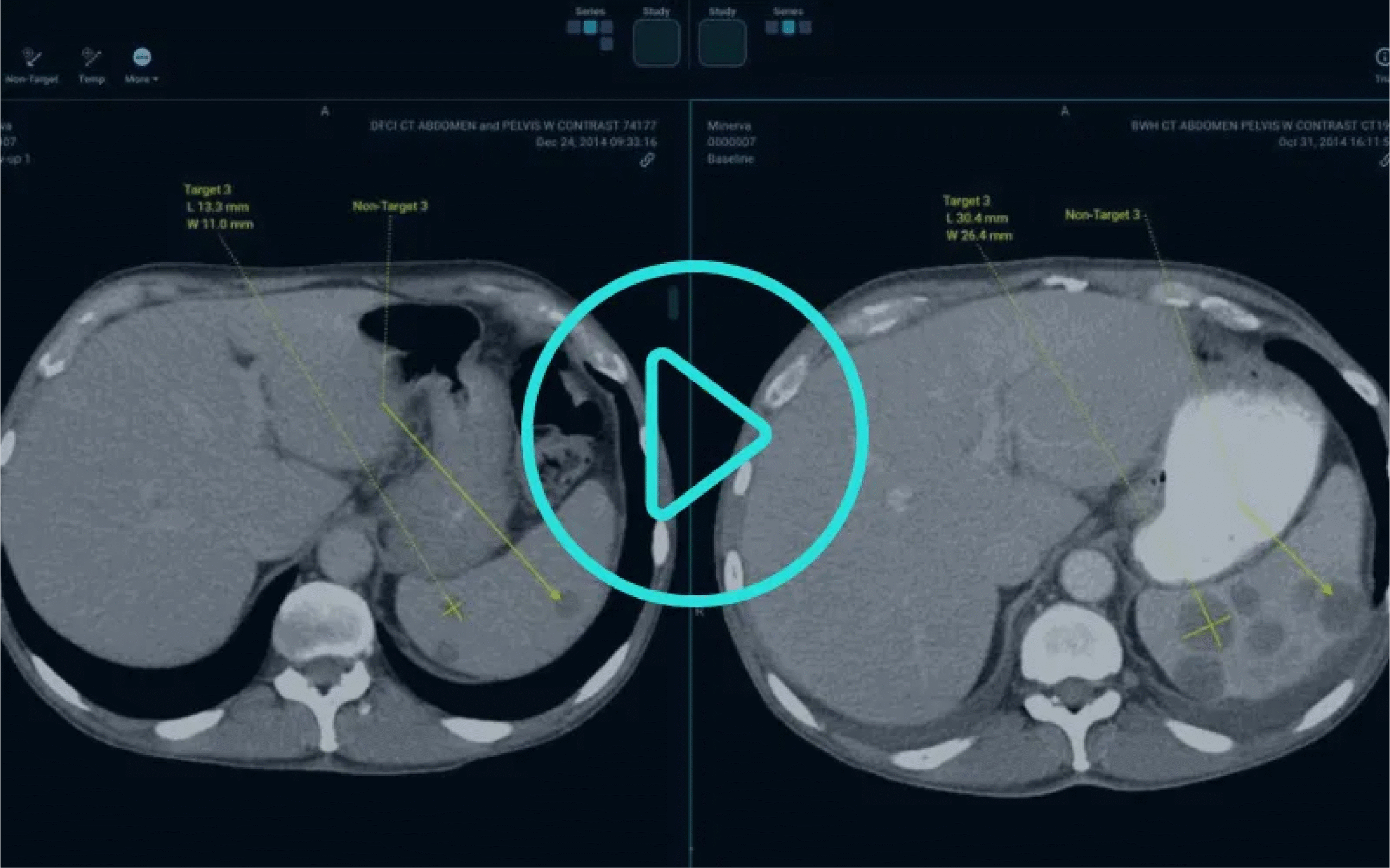 OHIF Viewer measuring tumor size to track oncology treatment progress over time