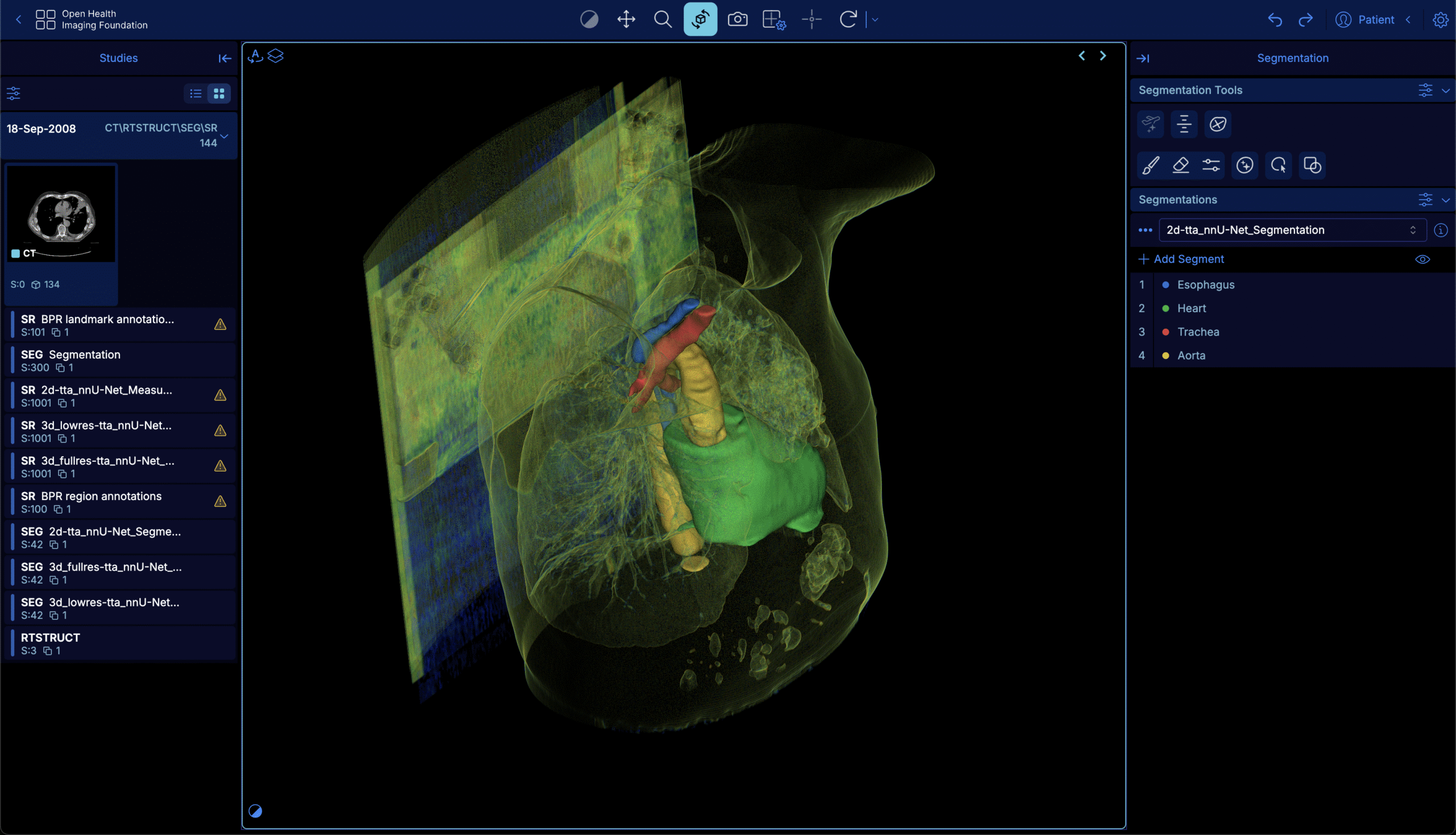 AI-assisted tools in OHIF Viewer creating lung segmentations on a 3D CT chest model.