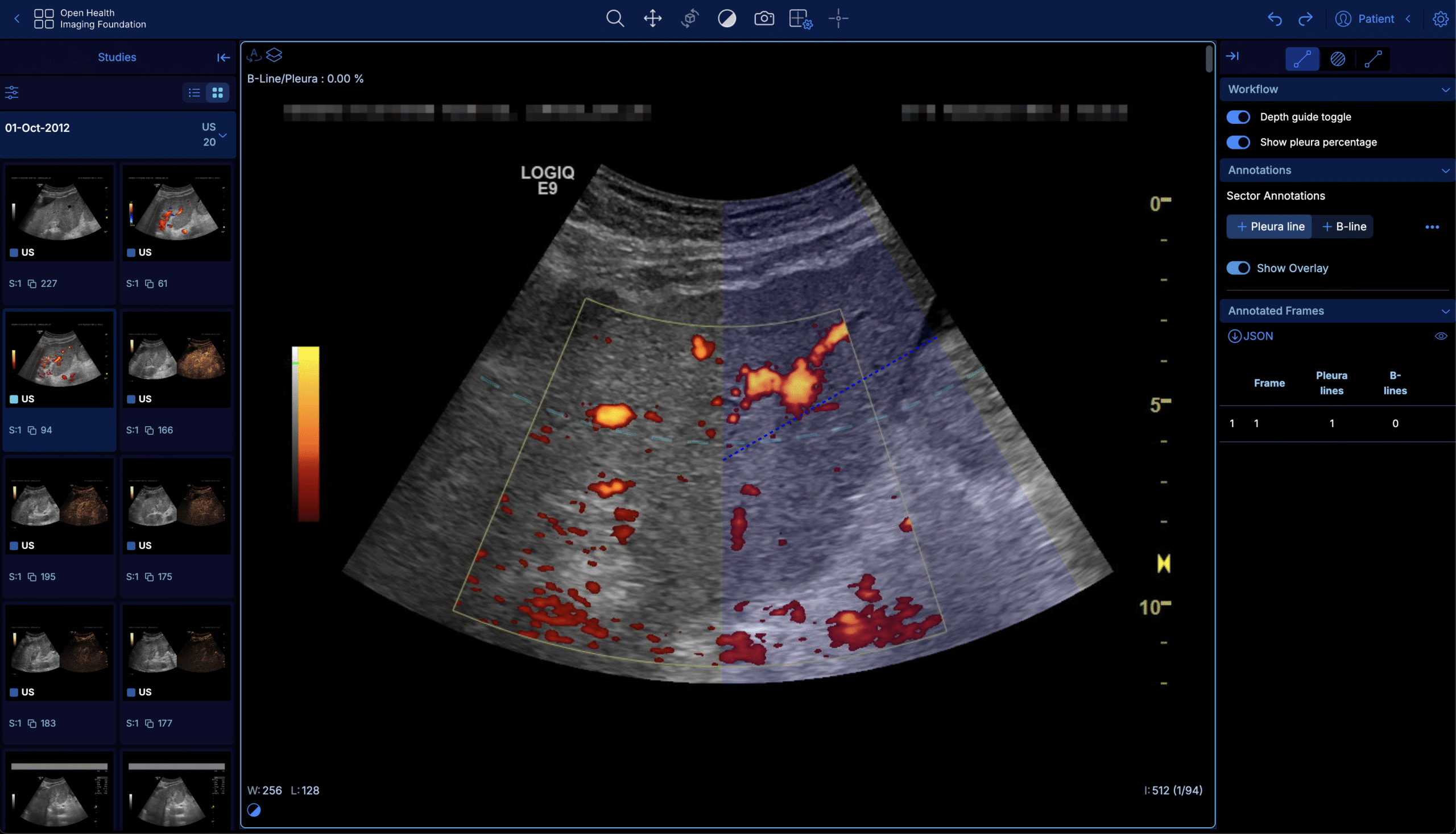 Drawing a pleura line annotation on a lung ultrasound image using OHIF Viewer's POCUS tools.
