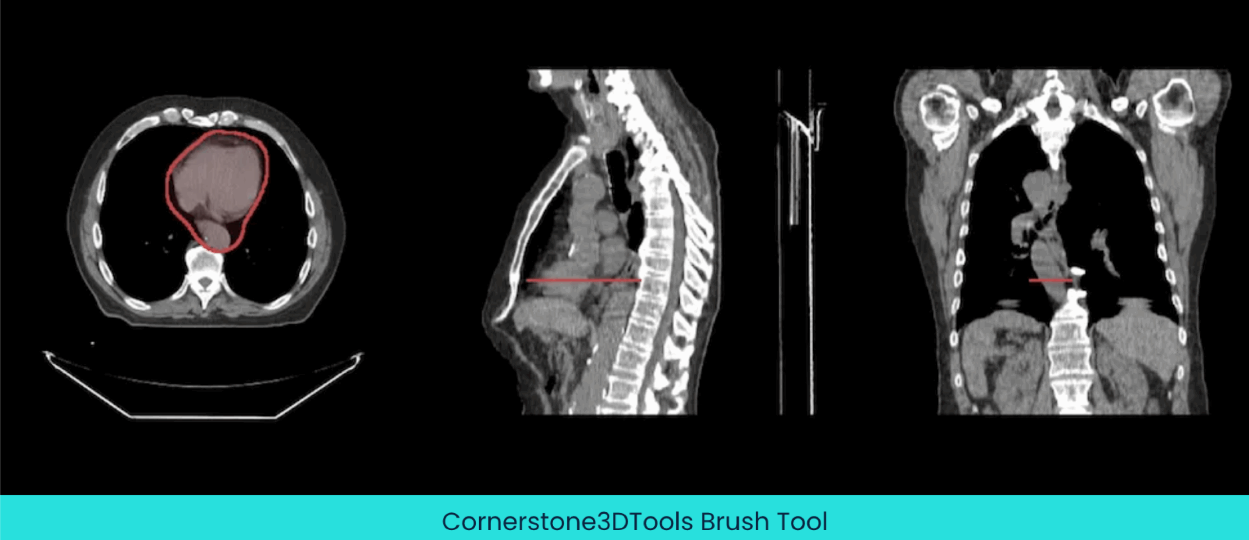 Cornerstone3DTools Brush Tool