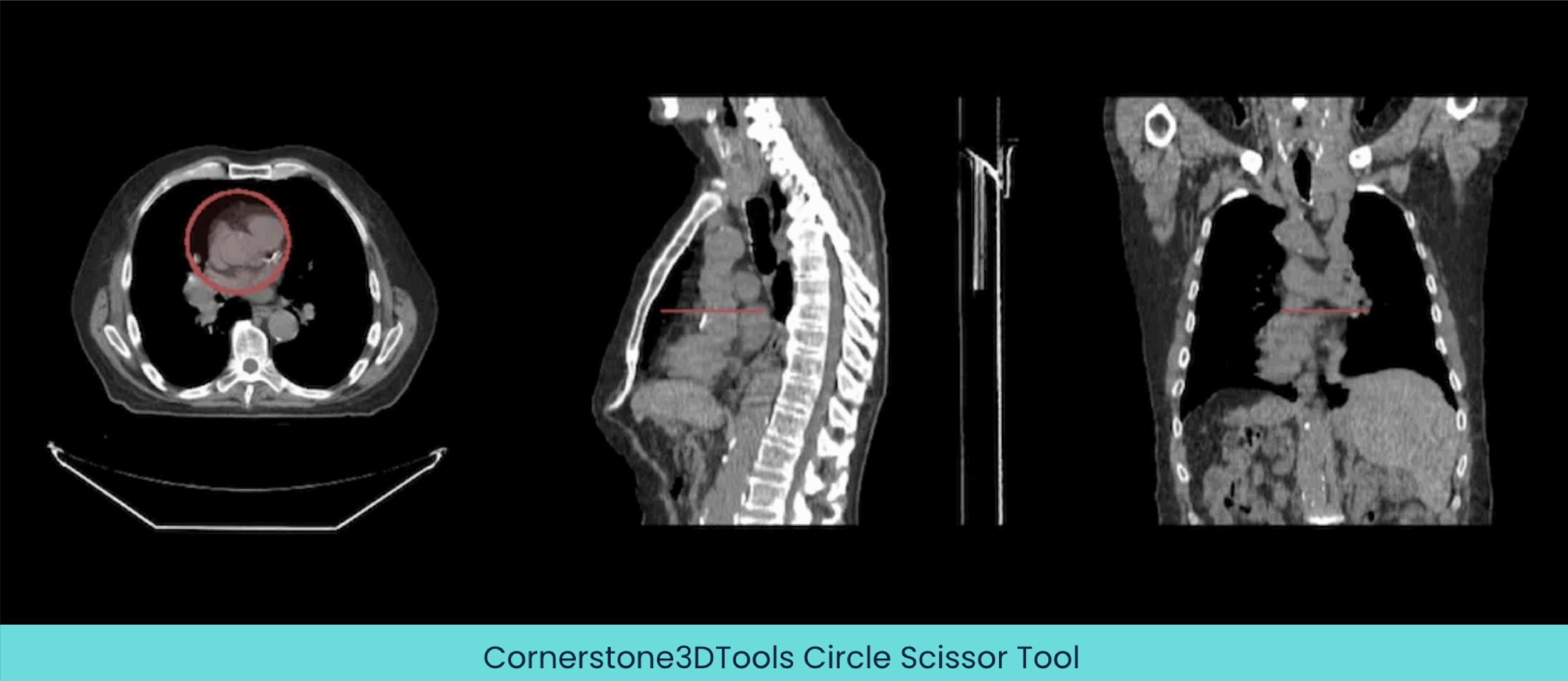 Cornerstone3DTools-Rectangle-Scissor-Tool