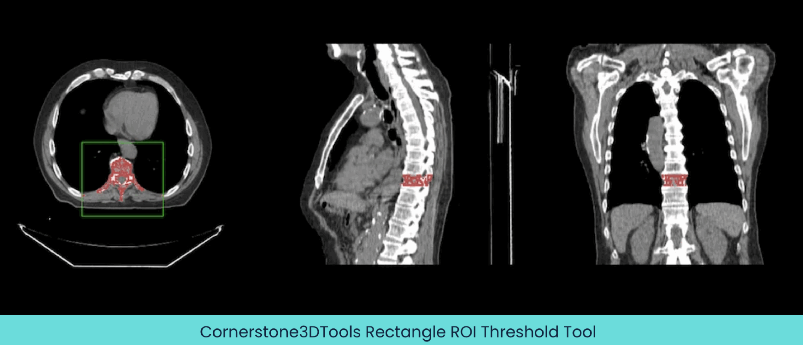 Cornerstone3DTools-Rectangle ROI Threshold Tool