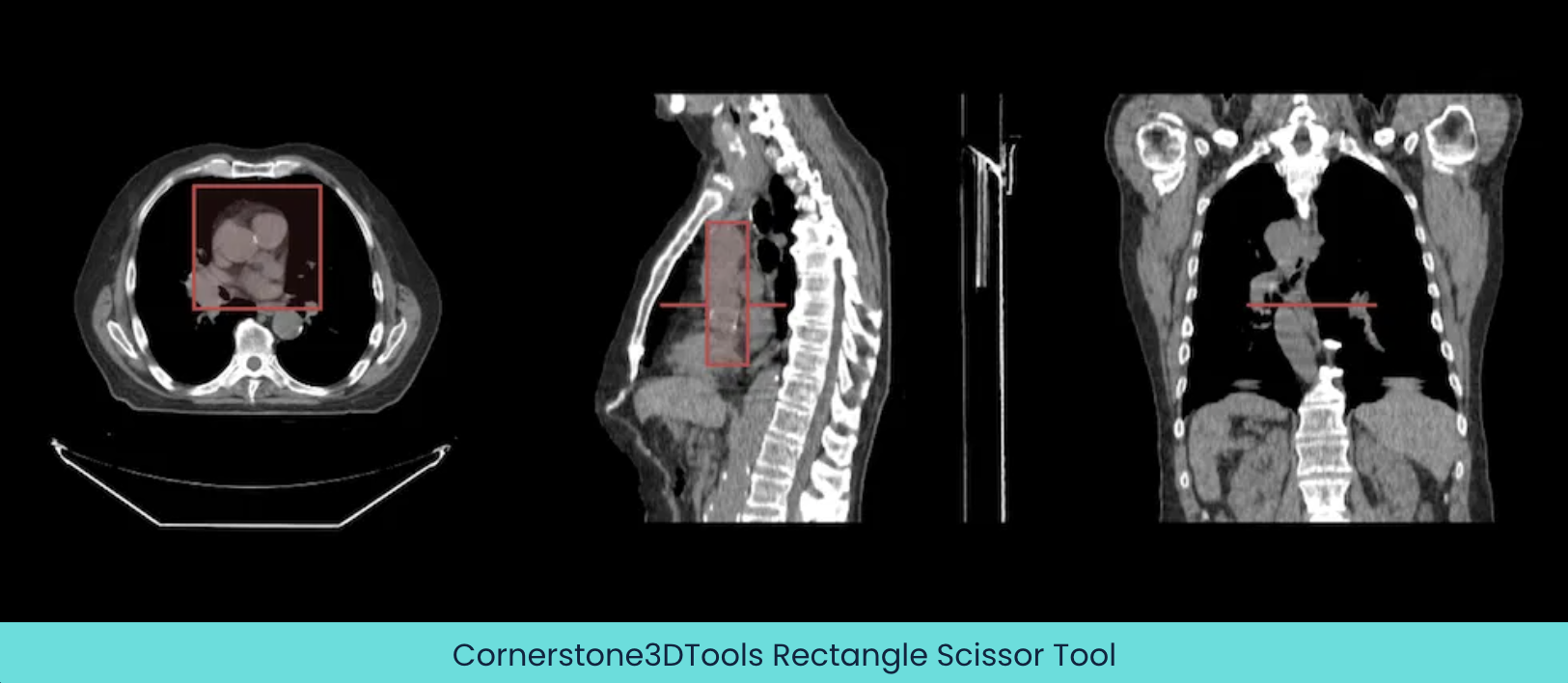 Cornerstone3DTools-Circle-Scissor-Tool